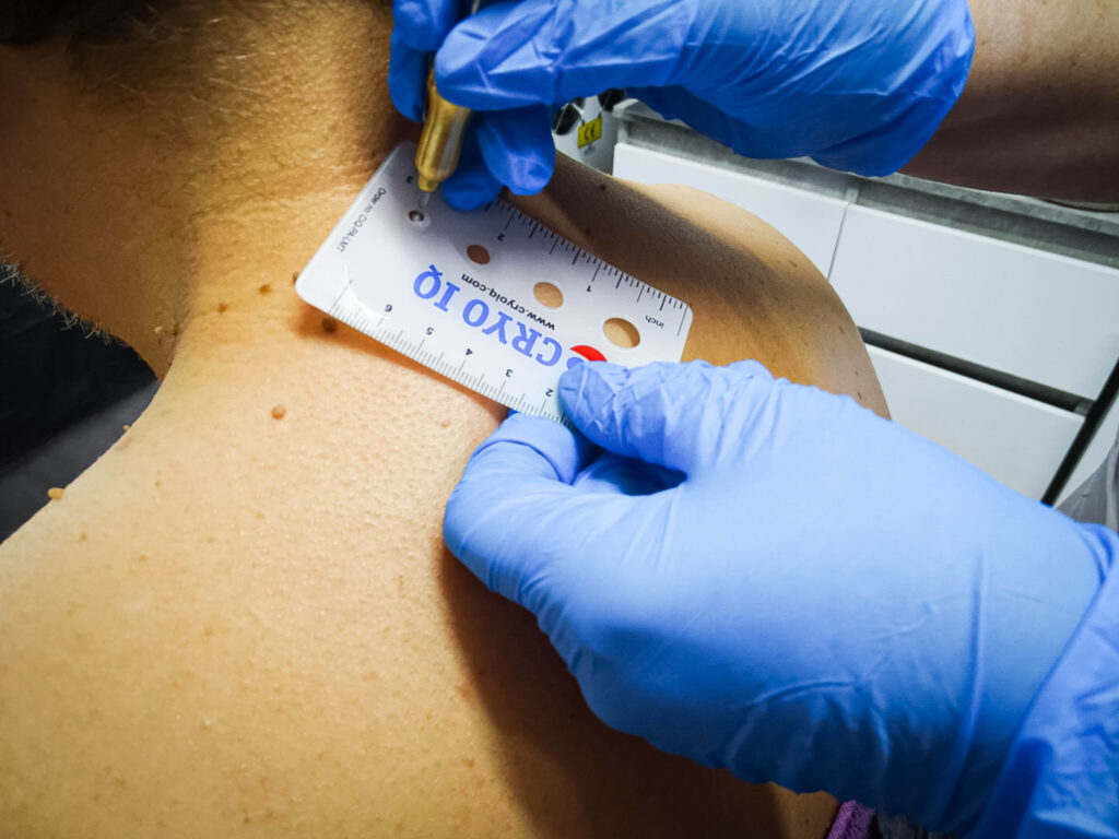 Skin booster treatment at Reflexions Skin Clinic