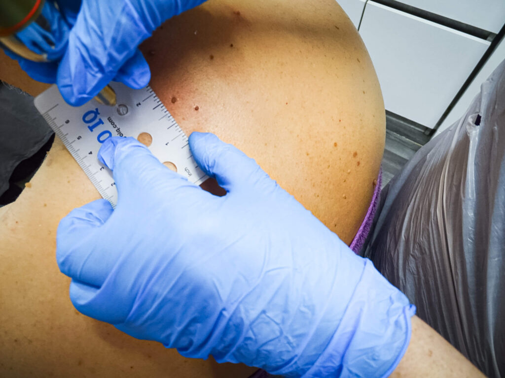 Cryotherapy treatment at Reflexions Skin Clinic