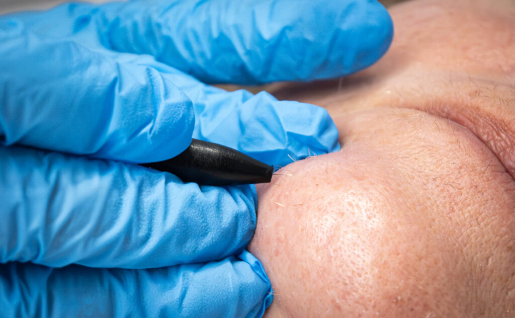 Electrolysis hair removal treatment at Reflexions Skin Clinic