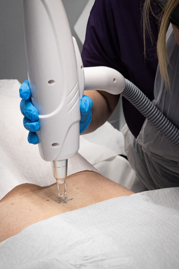 Nd:YAG laser tattoo removal treatment at Reflexions Skin Clinic