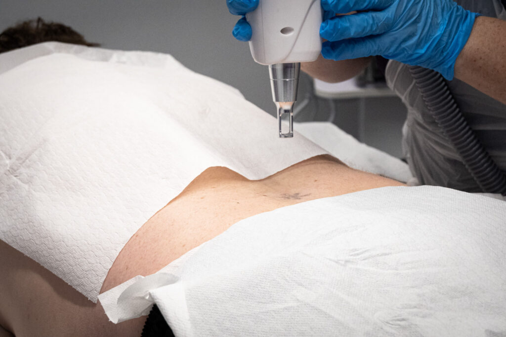 Nd:YAG laser tattoo removal equipment at Reflexions