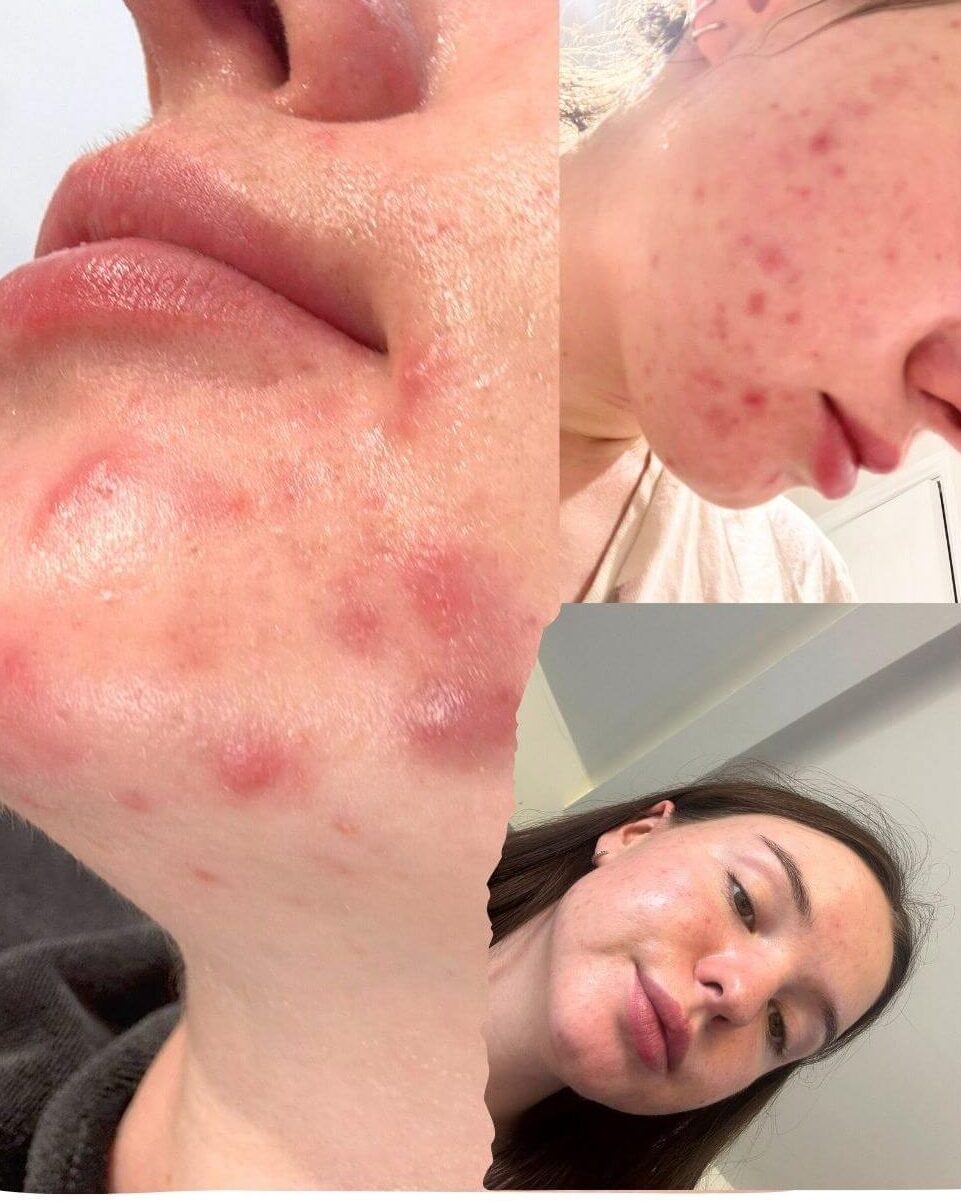 Cold plasma skin treatment at Reflexions Skin Clinic