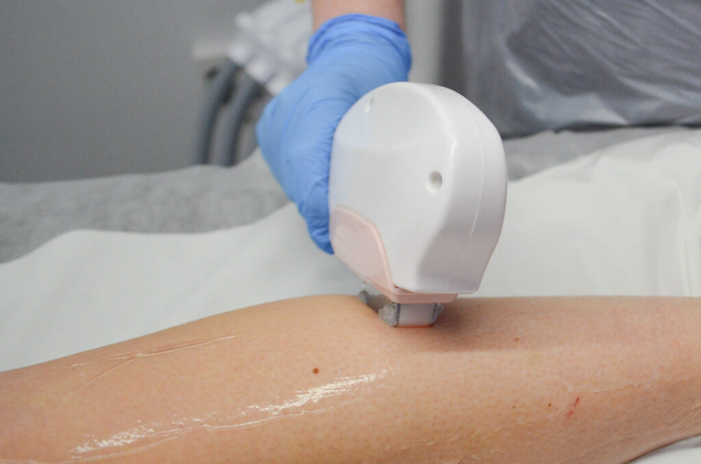 Laser hair removal treatment being applied to a client’s leg