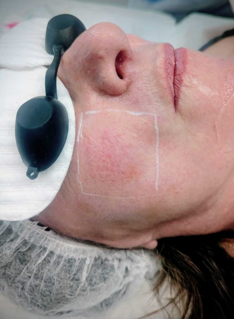 Client prepared for IPL skin rejuvenation treatment