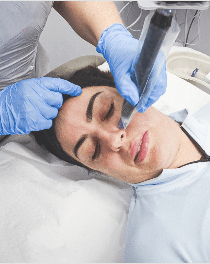 Microneedling treatment at Reflexions Skin Clinic